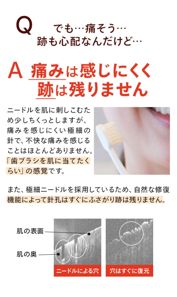 痛みは感じにくく、跡は残りません